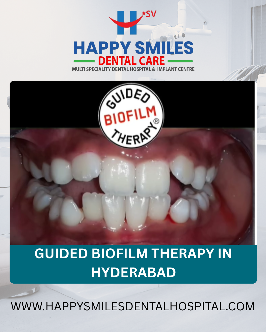 Guided Biofilm Therapy in Hyderabad