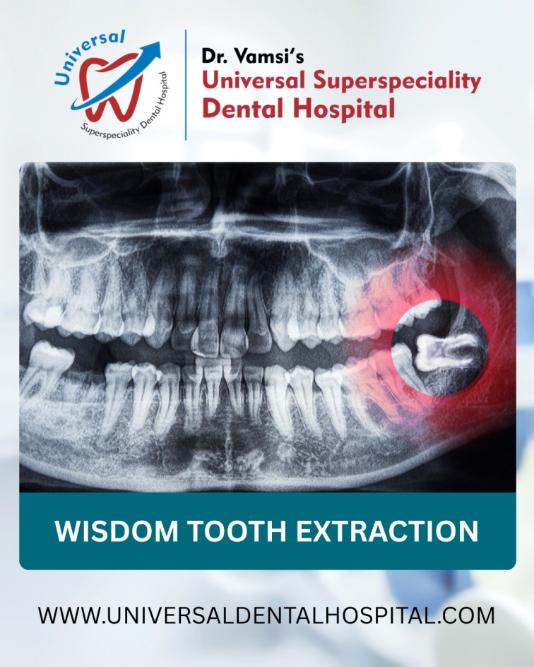 Wisdom Tooth Extraction – A Complete Guide for Pain-Free Recovery