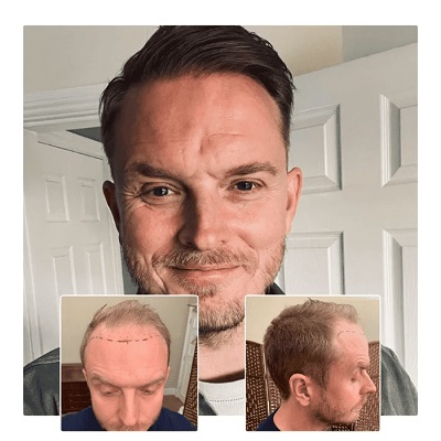 Capital Hair Restoration - Hair Transplant