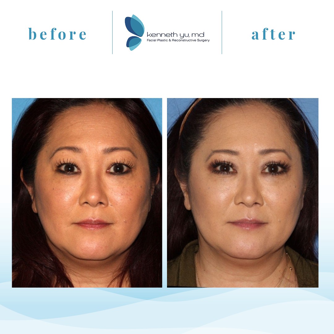 Kenneth Yu MD Facial Plastic & Reconstructive Surgery - Gallery 1