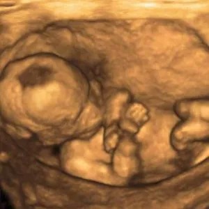 Tummy Vision 3D/4D Ultrasound & Gender Reveal - Gallery 3
